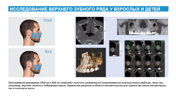 ИССЛЕДОВАНИЕ ВЕРХНЕГО ЗУБНОГО РЯДА У ВЗРОСЛЫХ И ДЕТЕЙ