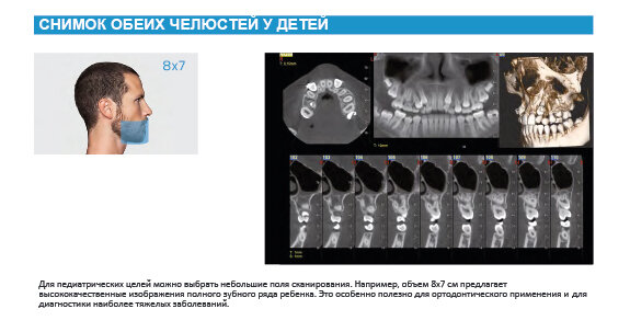 СНИМОК ОБЕИХ ЧЕЛЮСТЕЙ У ДЕТЕЙ